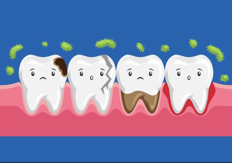karang gigi dan dampaknya sering disepelekan banyak orang, padahal dampak yang ditimbulkan bisa sangat mengganggu keseharian bahkan sampai masalah kesehatan umum. Nah, berikut merupakan hal-hal mengenai karang gigi yang perlu kamu ketahui.